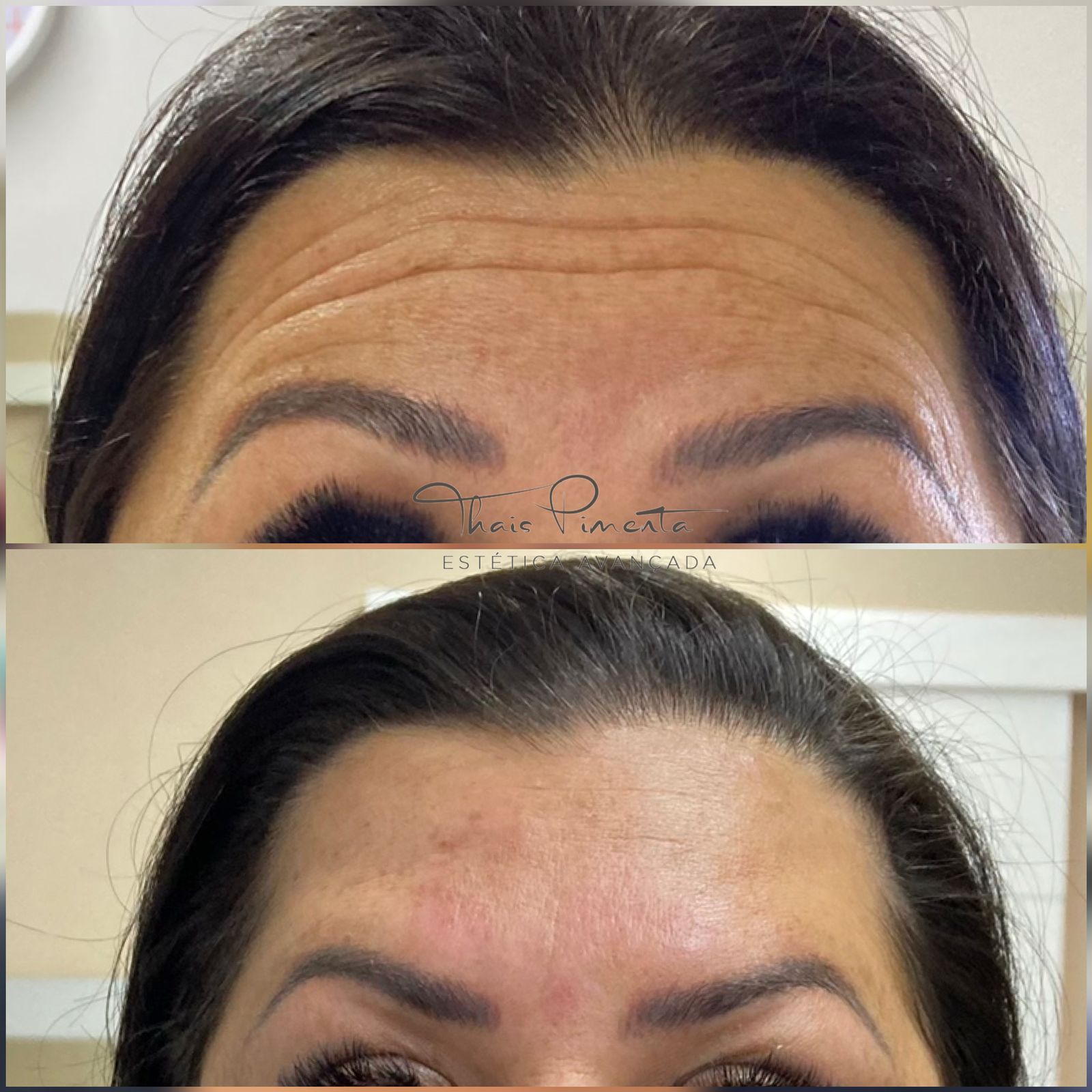 Botox
