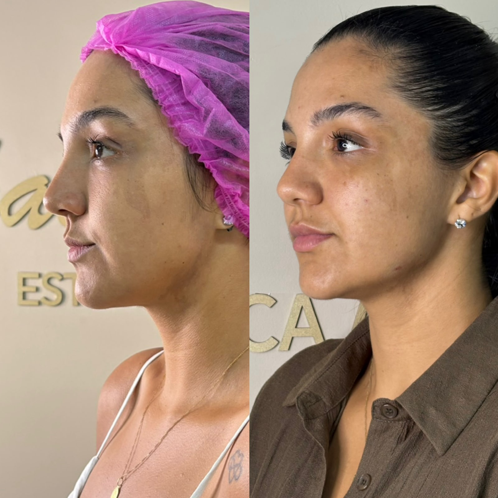 Harmonização Facial - Antes e Depois