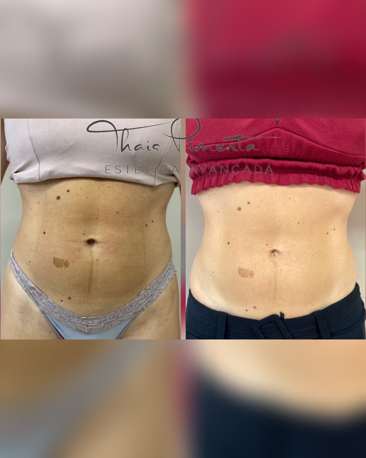 Lipo Enzimática