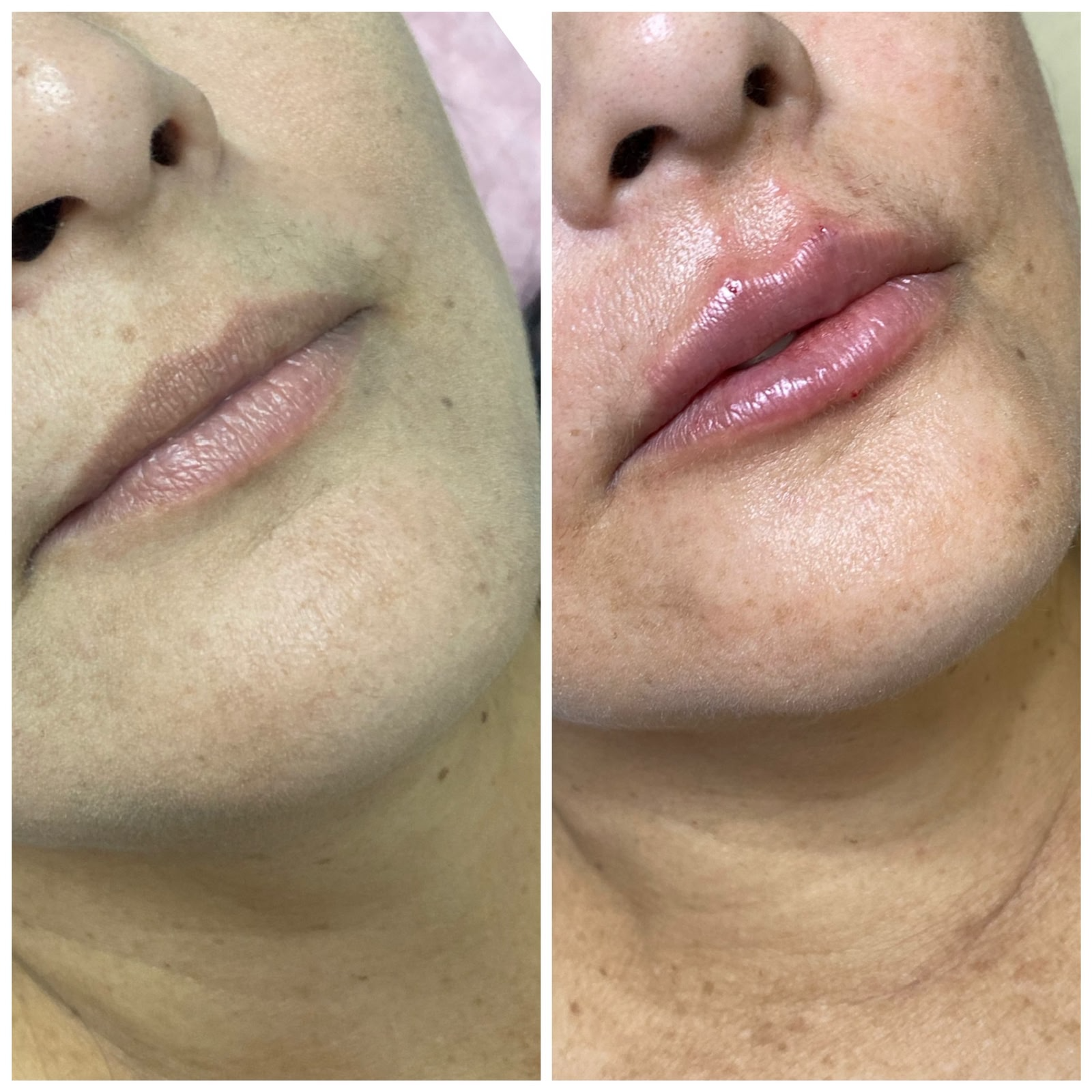 Preenchimento Labial - Antes e Depois